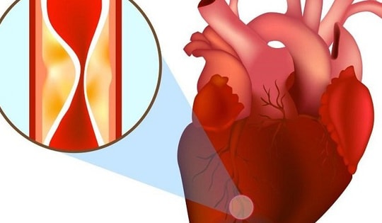 Bệnh nhân bị nhồi máu cơ tim cấp may mắn được cứu sống nhờ nhanh chóng làm việc này