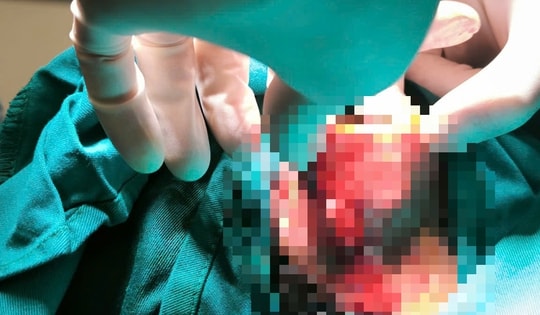 Bé trai 8 tuổi ở Hà Nội suýt mất tai do bị chó nhà cắn