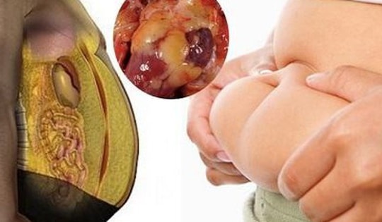 6 biến chứng đáng sợ của bệnh gan nhiễm mỡ, người mắc bệnh cần biết điều này để phòng biến chứng