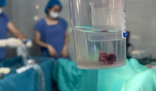 Bé gái 14 tuổi mắc đa polyp buồng tử cung hiếm gặp, bác sĩ khuyến cáo phụ huynh cần đặc biệt lưu ý nếu con gái có các dấu hiệu này