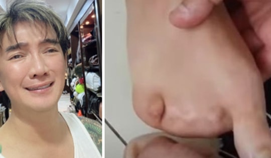 Phía Đàm Vĩnh Hưng lên tiếng về hình ảnh bàn chân bị biến dạng lan truyền trên mạng