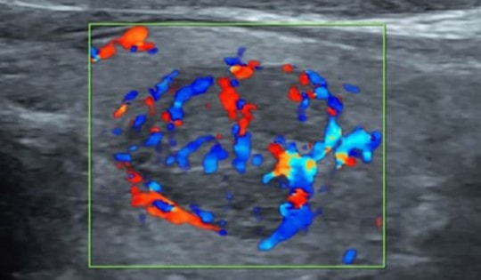 Thường xuyên ho khan, nuốt nghẹn, người đàn ông 53 tuổi được phát hiện ung thư