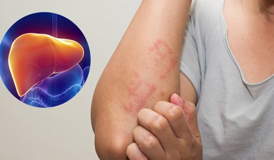 Dấu hiệu cảnh báo gan của bạn đang quá tải, cần thải độc gan càng sớm càng tốt