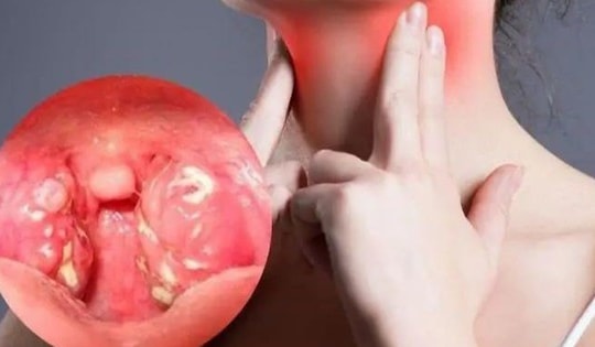 Biến chứng đáng sợ của viêm họng khi trời lạnh, dấu hiệu cần gặp bác sĩ gấp