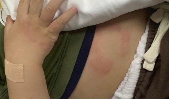 Mẹ thiếu sữa, bé 7 tháng tuổi bị sốc phản vệ liên tiếp sau 2 lần uống sữa công thức