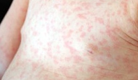 Đà Nẵng ghi nhận 1 ca tử vong liên quan đến bệnh sởi