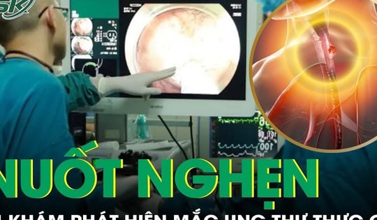 Khó nuốt kéo dài sau tết, người đàn ông phát hiện ung thư thực quản