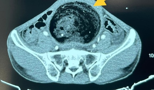 Người đàn ông bụng to như chửa sau 3 năm thường xuyên bị táo bón