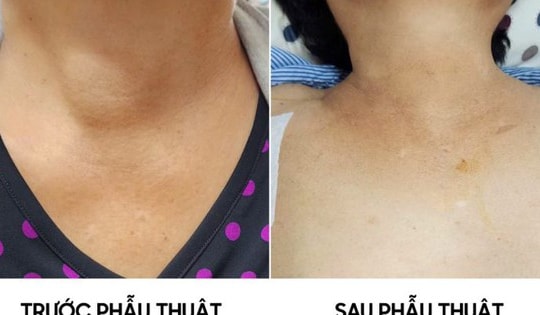 Người phụ nữ 59 tuổi phát hiệu u tuyến giáp từ dấu hiệu nhiều người Việt bỏ qua