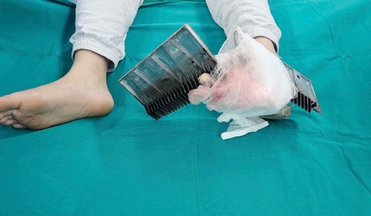 Bé trai ở Hà Nội đi cấp cứu với 2 miếng sắt thang cuốn găm sâu vào chân