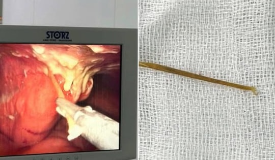 Người phụ nữ ở Cao Bằng bị thủng ruột non vì một sai lầm sau bữa ăn nhiều người Việt mắc phải