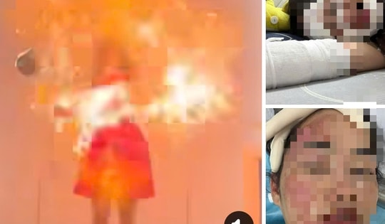 Cô gái bị bỏng mặt do nổ bóng bay gây sốc mạng xã hội