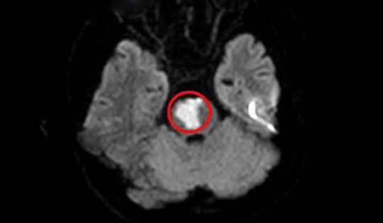 Bệnh nhân 17 tuổi bị nhồi máu não, thừa nhận phạm sai lầm nhiều người Việt dễ mắc phải