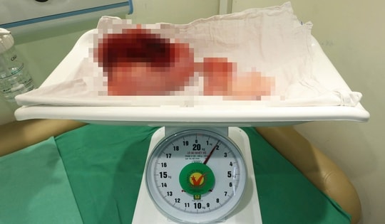 Tập thể dục đều đặn vẫn 'béo bụng', người phụ nữ 40 tuổi bất ngờ khi biết nguyên nhân