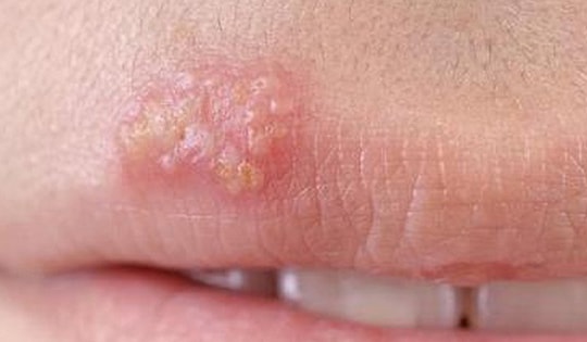 Thuốc trị mụn rộp do nhiễm herpes môi