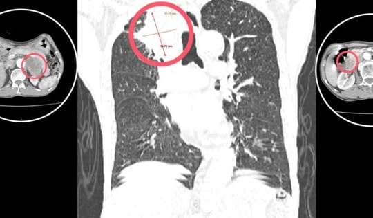 Người đàn ông bất ngờ phát hiện ung thư với 3 khối u thừa nhận không làm việc này trong 30 năm