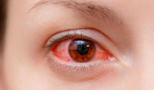 Thời điểm giao mùa, không khí ô nhiễm đề phòng mắc viêm kết mạc mùa xuân như thế nào?