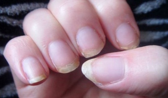 5 dấu hiệu phổ biến cảnh báo thiếu hụt vitamin và khoáng chất thiết yếu