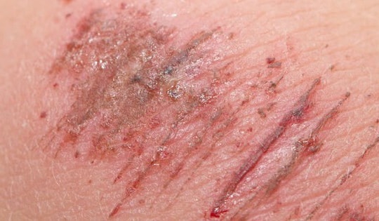 Liên tiếp 2 trường hợp nhiễm khuẩn tụ cầu vàng từ vết xước và nốt mụn nhỏ trên mặt