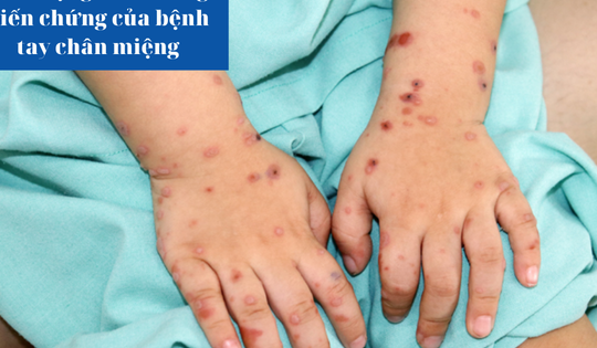 Cẩn trọng với biến chứng của bệnh tay chân miệng