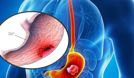 4 thực phẩm giúp phòng ngừa viêm loét dạ dày hiệu quả, người Việt nên ăn để phòng bệnh
