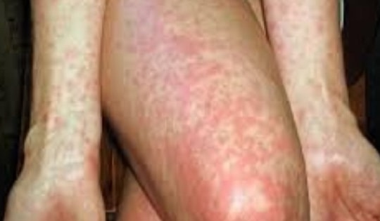 Bé gái sốt cao, nổi ban toàn thân từ căn bệnh hay gặp mùa đông xuân, bác sĩ khuyến cáo cách phòng ngừa