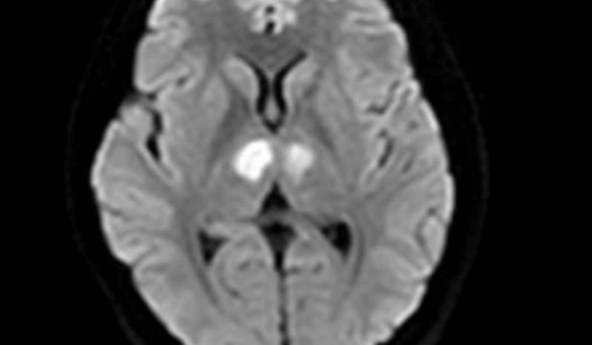 Người phụ nữ 21 tuổi ở Hà Nội bị tổn thương não nặng, thừa nhận sai lầm uống thuốc giảm cân mua trên mạng xã hội