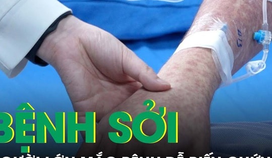 Vì sao người lớn mắc sởi dễ có nguy cơ biến chứng nặng?