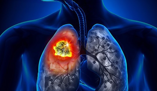 Ứng dụng trí tuệ nhân tạo để phát hiện sớm, nâng hiệu quả chẩn đoán, điều trị ung thư phổi