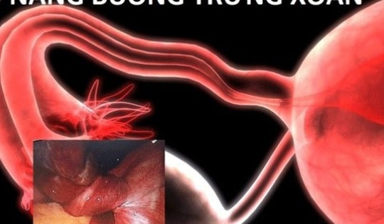 Thai phụ 40 tuổi bất ngờ phát hiện u nang buồng trứng xoắn từ dấu hiệu đáng sợ này trong lúc mang thai