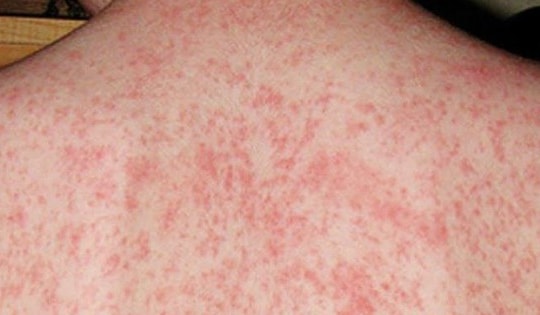 Hà Nội: Hơn 100 trường hợp mắc sởi trong tuần, khuyến cáo cách bảo vệ con trong những ngày thời tiết nồm ẩm