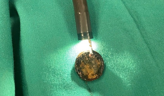 Bé gái 4 tuổi gặp nguy hiểm do nuốt phải pin cúc áo, bác sĩ khuyến cáo việc nên làm để ngăn ngừa tai nạn cho trẻ