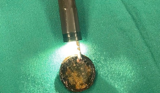 Hồi hộp 3 giờ lấy pin cúc áo kẹt trong thực quản trẻ nhỏ