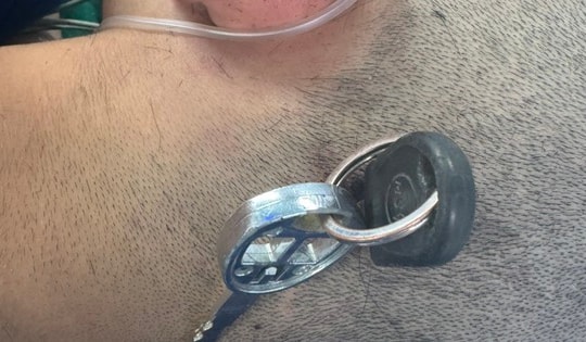 Nam sinh đi cấp cứu vì bị chìa khóa cắm sâu vào đầu