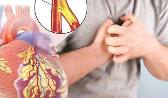 Bệnh mạch vành gây biến chứng nguy hiểm