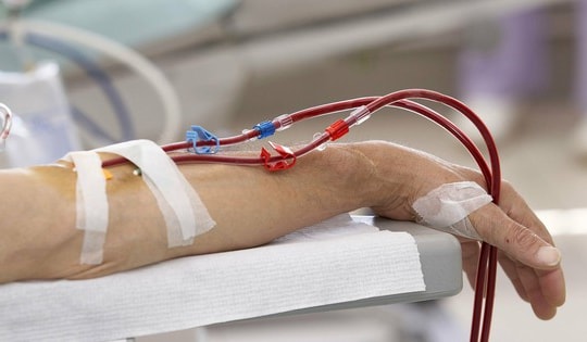 Chuyên gia nói gì khi nhiều người đi lọc máu để loại bỏ mỡ máu, ngừa đột quỵ?