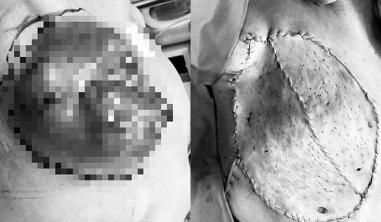 Người phụ nữ 34 tuổi bị biến dạng ngực nghiêm trọng, hoại tử sâu sau điều trị ung thư vú