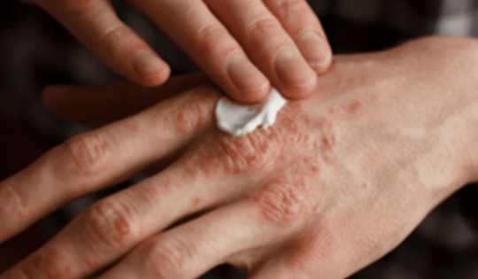 4 lưu ý dùng thuốc giúp kiểm soát bệnh vảy nến thành công