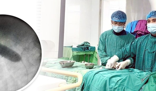 Can thiệp qua da cứu bệnh nhi 3 tuổi bị hẹp eo động mạch chủ