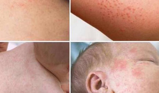 876 ca bệnh sởi chỉ trong 2 tháng đầu năm, Hà Nội đẩy mạnh tiêm vaccine để ngăn dịch sởi