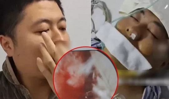 Mảnh xương vịt nằm trong phổi suốt 2 năm gây biến chứng nặng