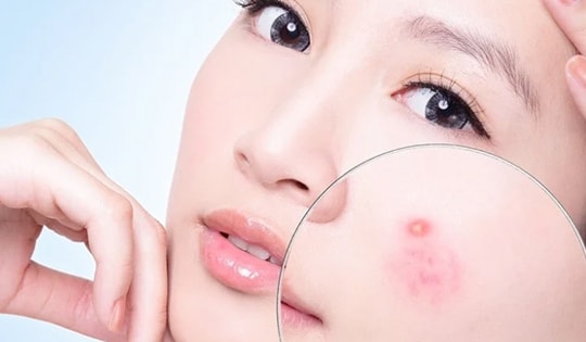 Sản phẩm trị mụn của thương hiệu La Roche Posay bị thu hồi ở Mỹ khiến nhiều tín đồ làm đẹp ở Việt Nam hoang mang