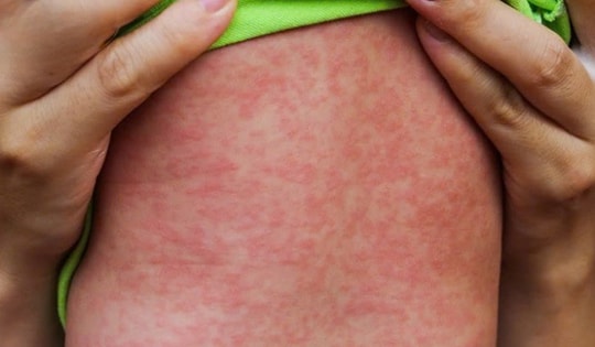 Bệnh sởi lây lan nhanh, Bộ Y tế khuyến cáo biện pháp hữu hiệu để phòng bệnh