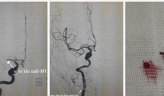 Đang đun bếp lúc sáng sớm, người phụ nữ 49 tuổi bất ngờ bị đột quỵ