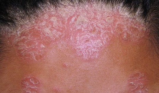 Thuốc nào trị bệnh vảy nến da đầu?