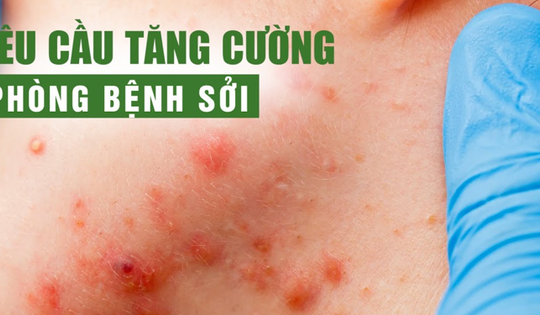 10 thông điệp về bệnh sởi nhất định không được bỏ qua!