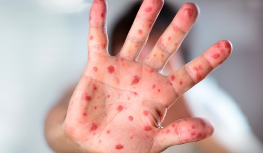 5 khuyến cáo phòng, chống bệnh sởi