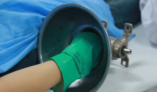 Người phụ nữ ở Hà Nội đi cấp cứu với bàn tay bị kẹt trong máy xay thịt