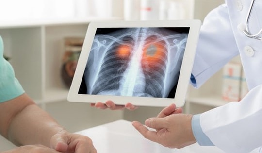 Căn bệnh khiến người đàn ông có 72 lỗ thủng trong phổi, mất khi 28 tuổi