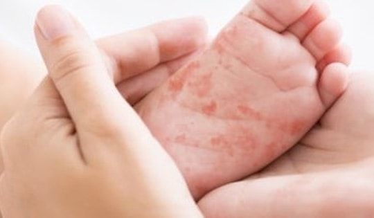 Bé gái 4 tuổi ở Hà Nội tử vong do mắc sởi